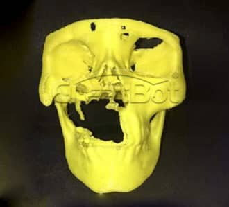 Humerus and upper jawbone PEEK implant 01