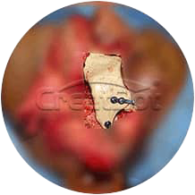 {{$t('peek-medical-case.osLacrimale.alt7')}}