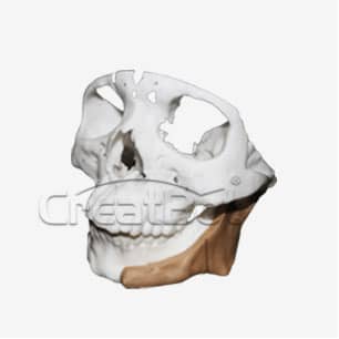 Lower jawbone PEEK implant 01