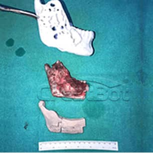Lower jawbone PEEK implant 02